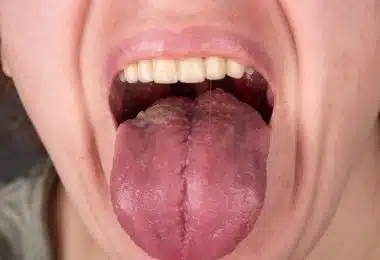 Cancer de la langue