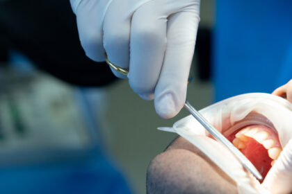 Implant dentaire sans douleur : le rôle de l’anesthésie générale pour un confort optimal